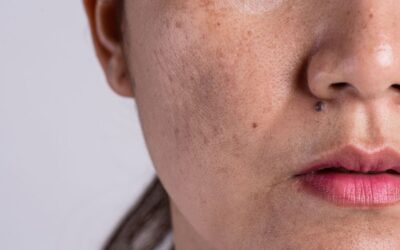 Melasma